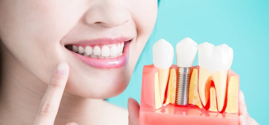 Решиться ли на зубной имплант — все плюсы и минусы