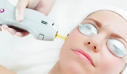 Лазерное омоложение: когда пора начинать и какие результаты ожидать