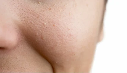 Что такое белые угри и как их лечить