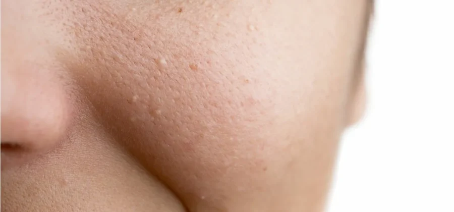 Что такое белые угри и как их лечить