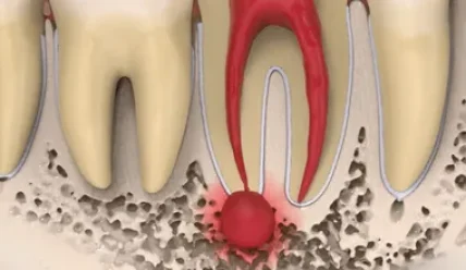 Лечение гранулемы зуба: современные подходы к здоровью и красоте улыбки