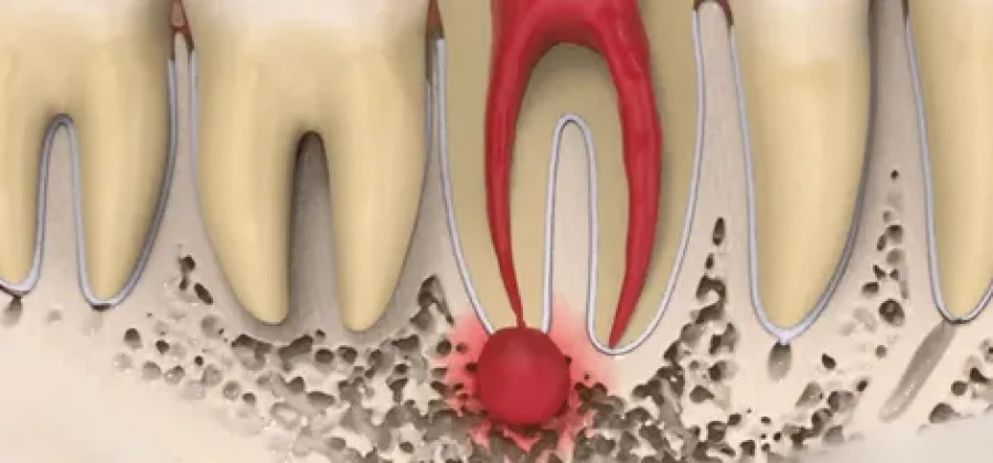 Лечение гранулемы зуба: современные подходы к здоровью и красоте улыбки
