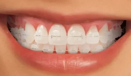 Прозрачные брекеты: как проходит установка и что нужно знать