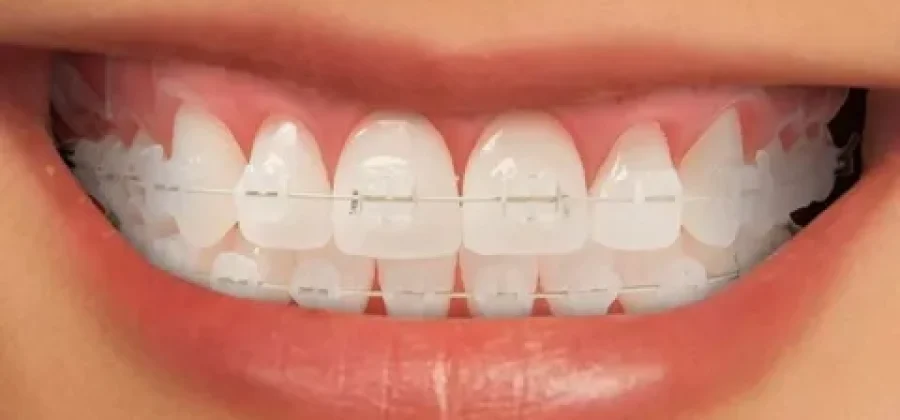 Прозрачные брекеты: как проходит установка и что нужно знать