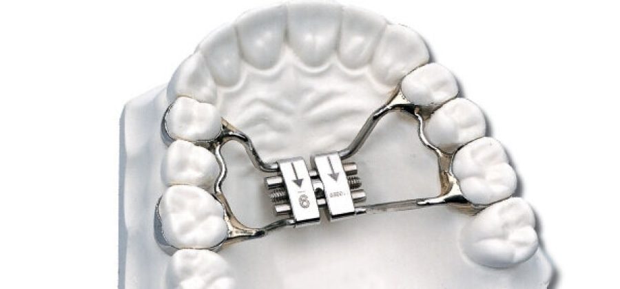 Несъемные ортодонтические аппараты для детей: путь к здоровой улыбке
