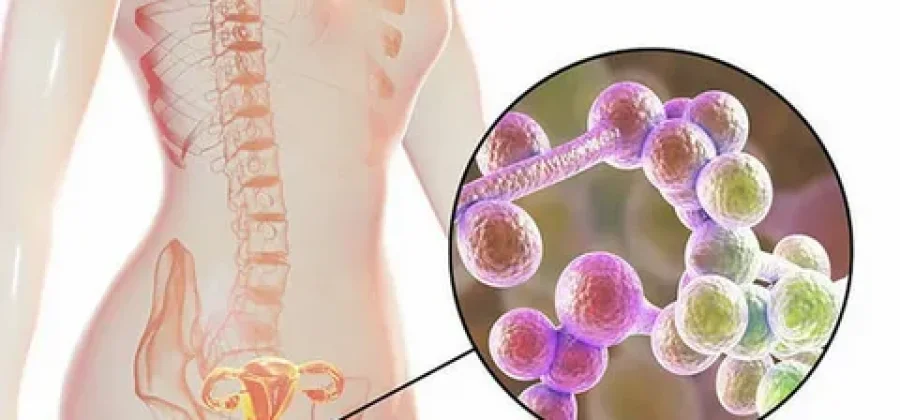 Сладкая жизнь и молочница: почему диета важна для женского здоровья